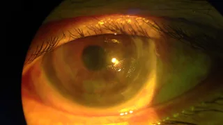 Poor scleral lens surface wetting