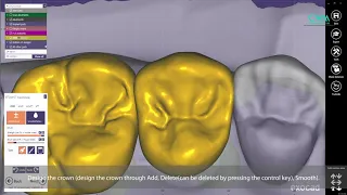 [Demo] How to design zirconia custom abutments and crowns (Part. 2 Design)