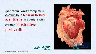 CVPP: (WK7) (Thursday) (SPR 21):Cardiac tamponade, Kussmaul's sign, pulsus paradoxus, and EKG PT 1