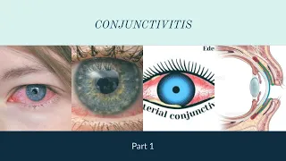 CONJUNCTIVITIS : PART- 1 | The White Army