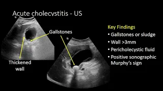 GI imaging - Gallstones and their consequences