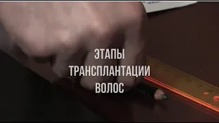 ЭТАПЫ ТРАНСПЛАНТАЦИИ ВОЛОС