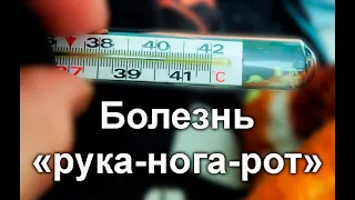 Вирус Коксаки / Герпетическая ангина у ребенка: как отличить от ангины? / Как отличить от ветрянки?