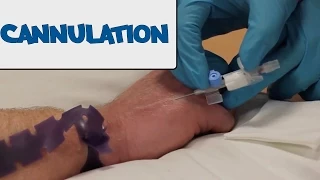 How to Perform Cannulation - OSCE Guide (old version) | UKMLA | CPSA