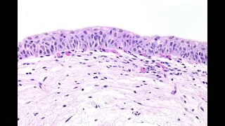 Diagnosis, Staging, and Grading of Urothelial Carcinoma by Jonathan I. Epstein, M.D.