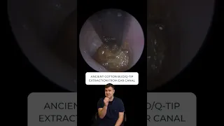 ANCIENT COTTON BUD/Q-TIP REMOVAL FROM EAR CANAL - EP756