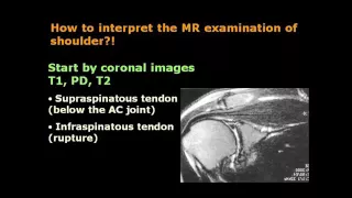 How interpret Shoulder MRI     Dr Mamdouh Mahfouz