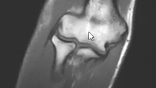 How to Read an MRI of the Elbow | First Look MRI