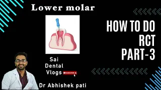HOW TO DO RCT PART 3 / LOWER MOLARS