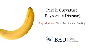 Peyronie's Disease Surgery - Plaque Incision and Grafting