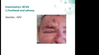 Approach to Uveitis