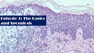 Episode1: A Survey of Dermatopathology: The Basics and Spongiosis