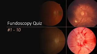 Fundoscopy Quiz