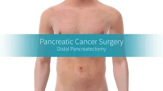 Distal Pancreatectomy: How the Procedure Is Performed