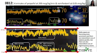 Using EEG Wave Forms +Pharmacokinetic Modeling During Induction & Maintenance (BIS monitor specific)