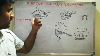 Anterior maxillary osteotomy - Wassmund method