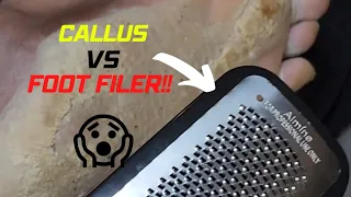 CALLUS VS FOOT FILER!! Pt 1