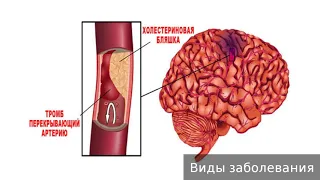 Инфаркт мозга. Как лечить инфаркт мозга.