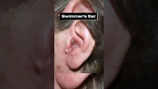 The #1 Worst Thing to Do for Ear Pain (Best Way to Avoid Swimmer’s Ear)