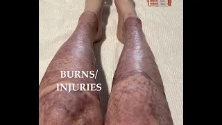 My burns / injuries