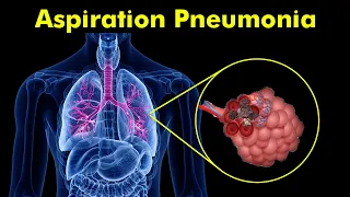 Breathing Trouble: Understanding Aspiration Pneumonia