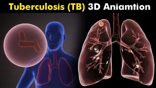 What Happens in Tuberculosis (TB)? | 3D Animation | Types, Causes, Symptoms, Treatment (Urdu/Hindi)