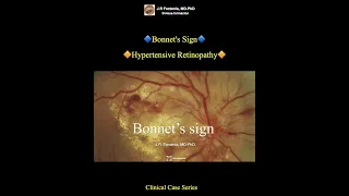 Bonnet's Sign. Hypertensive Retinopathy.