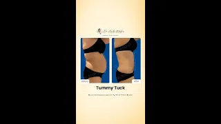 🧐 Want flat Tummy, Weight loss | Live Procedure Liposuction before after result #shorts #tummytuck