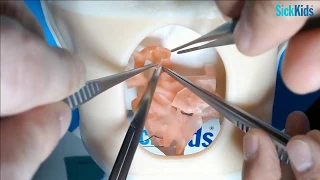 HOST - Norwood operation (Augmentation-reimplantation technique) on 3D model - Dr DJ Barron (FULL)