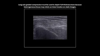 Full-thickness tear of the supraspinatus tendon on shoulder ultrasound (case 5)