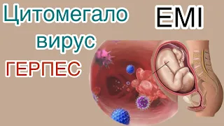 ЦИТОМЕГАЛОВИРУС.ЦМВ.ВПГ ИНФЕКЦИЯ#тренды#беременность