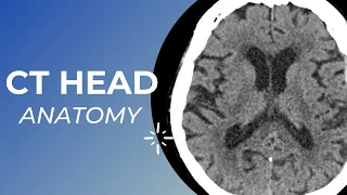 CT head anatomy for Medical students , residents and clinicians.