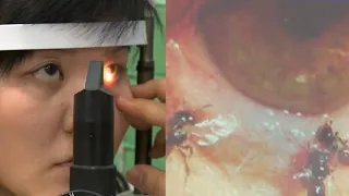 4 Bees Found Living in Woman's Eye