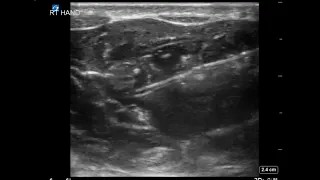 Wrist Ultrasound: Median Nerve Block for Hand Abscess