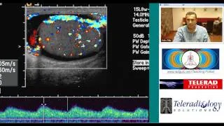 Ultrasound of Acute Epididymo Orchitis by Dr Arjun Kalyanpur