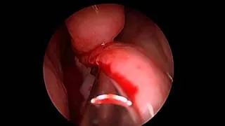 Endosopic Septoplasty - Correction of a deviated septum