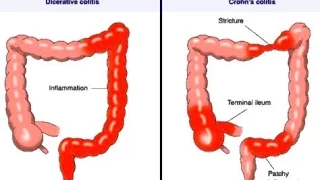 Crohn Disease