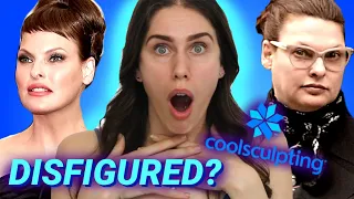 A Model Tried Coolsculpting. This is what happened to her body…