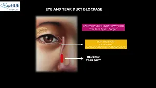 BLOCK TEAR DUCT PART 1 / WATERING IN EYES / ENDOSCOPIC DACRYOCYSTORHINOSTOMY / TEAR DUCT SURGERY