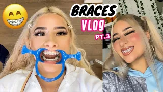 BRACES VLOG PT.3 ✨ | JESSICA GOLD