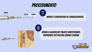 Toracocentese - Prática Clínica Cirúrgica I - UNEB