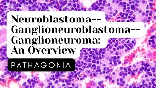 Neuroblastoma--Ganglioneuroblastoma--Ganglioneuroma: Overview #pathagonia #endocrine #pathology