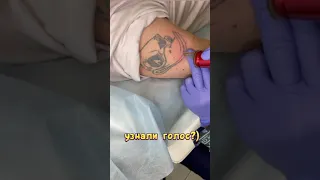 Удаление татуировки александритовым лазером в Москве (Непосредственно Каха)
