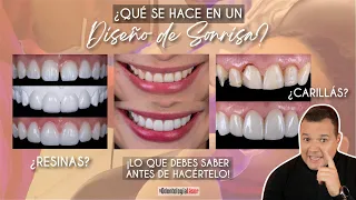 ¿Qué se hace en un diseño de sonrisa? 🦷 Lo que debes saber antes de hacértelo 🤔 - Odontología Láser