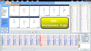 Программа анализа суточного ЭКГ холтер HEACO (обзор)