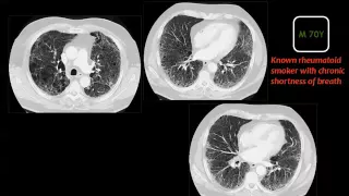 Chest imaging quiz II  Prof Dr  Mamdouh Mahfouz In Arabic