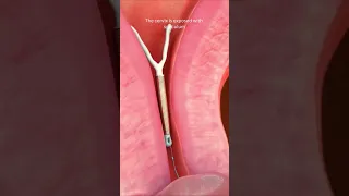 IUD Removal 🤔#shortvideo #viral