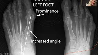 Bunions! Myths, Misconceptions & Movement with Dr Emily Splichal