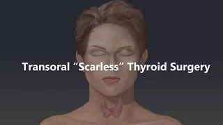 Transoral 'Scarless' Thyroid Surgery Animation