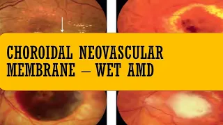 Choroidal neovascular membrane (CNV) | Wet AMD | TYPE 1 CNVM, type 2 CNVM, type 3 CNVM ,RAP